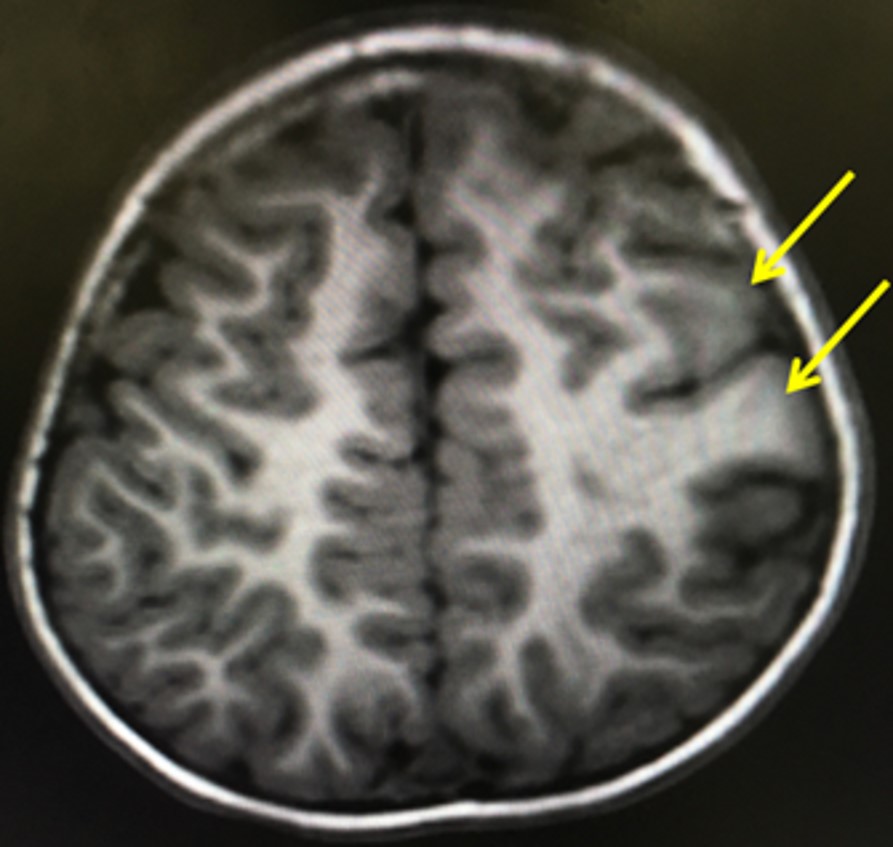 術前MRI画像