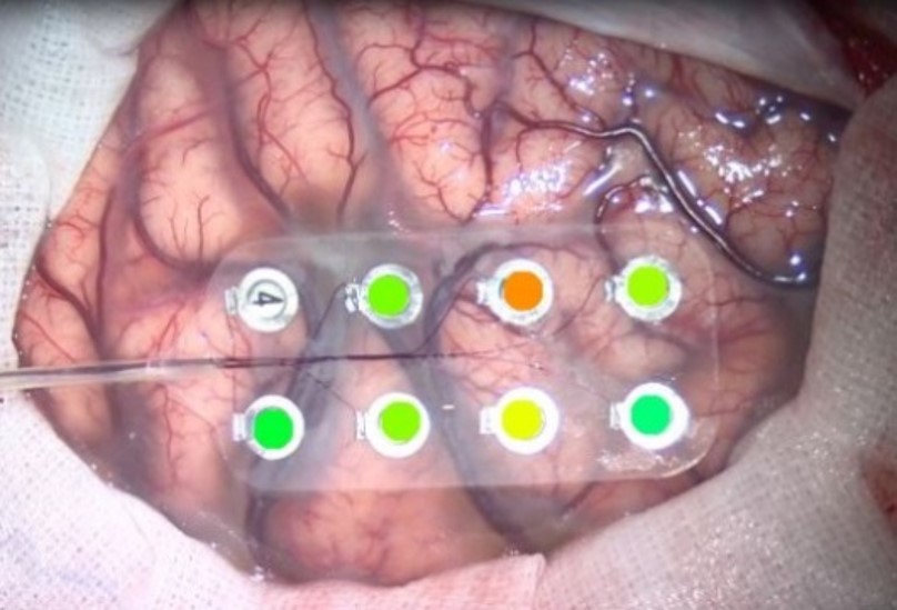 術中頭蓋内脳波を用いたてんかん焦点可視化技術