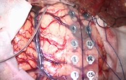 術中脳波を確認して病変部を評価