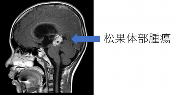 松果体部腫瘍