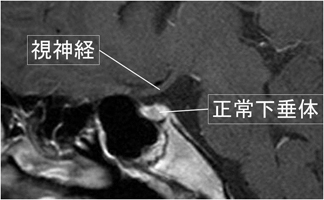 下垂体のMRI