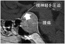 下垂体腺腫のMRI