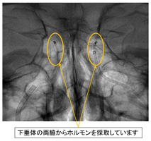 下垂体の両脇からホルモンを採取しています