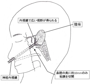 神経内視鏡を用いた手術のイメージ
