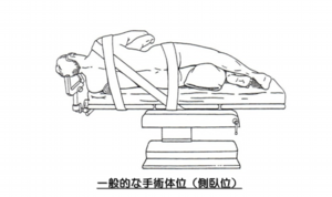 一般的な手術体位(側臥位)